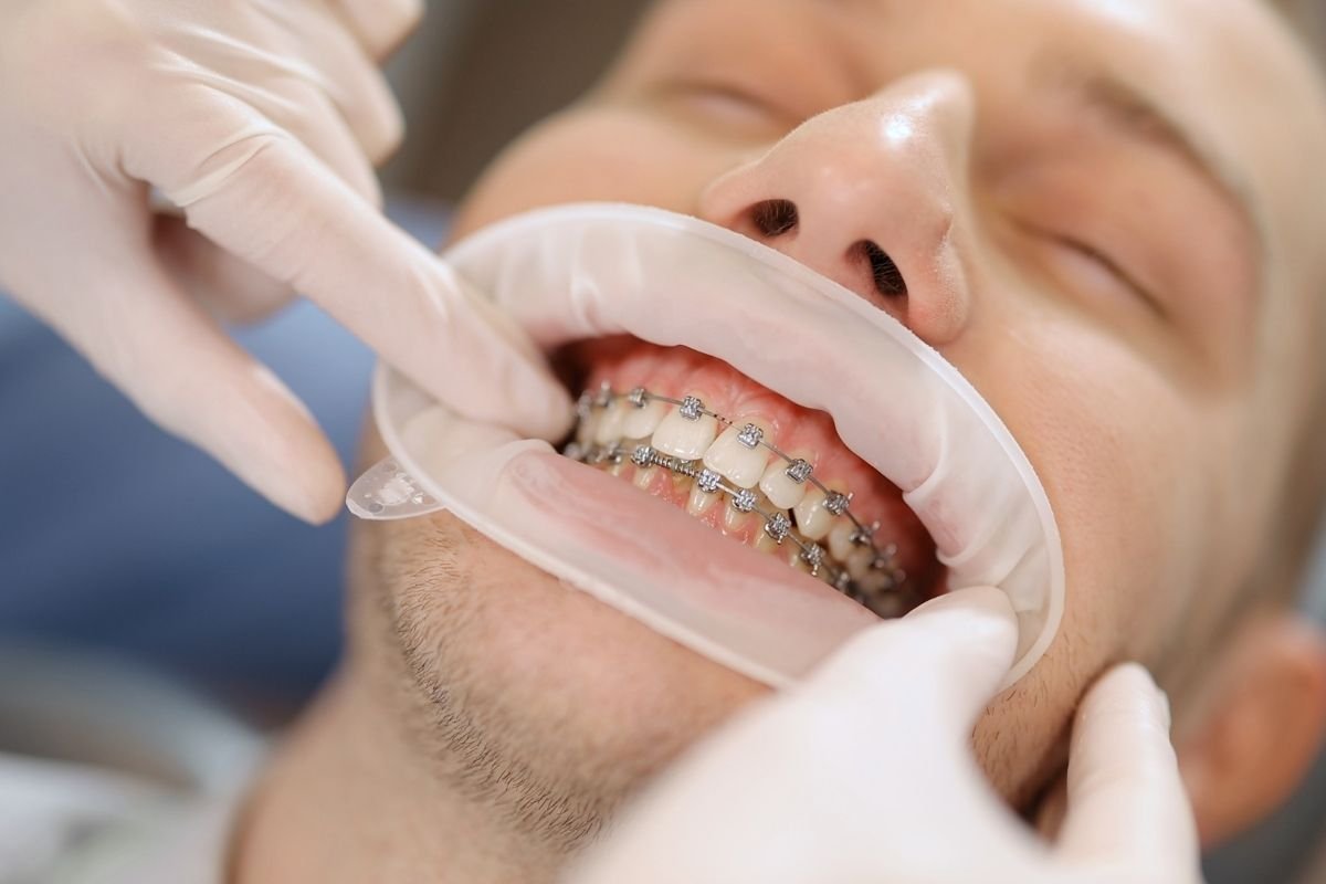 Diş Teli Tedavisinde Ağrı Olur mu?