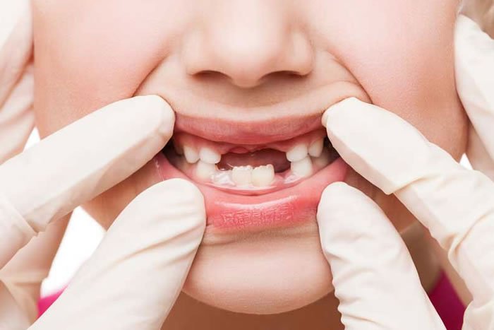 Çocuklarda Kuron Kaplama