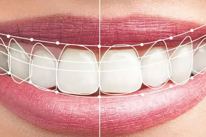 Dijital Gülüş Tasarımı (DSD – Digital Smile Design)