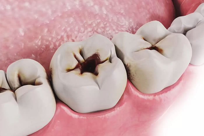 Diş Çürükleri Nasıl Oluşur?