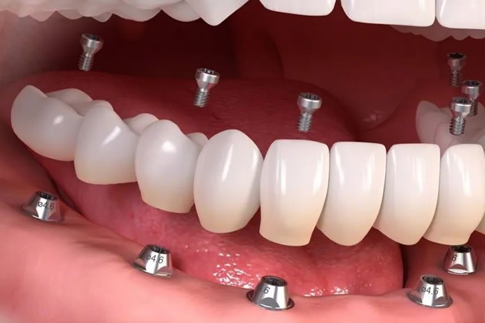 Full Ağız İmplant (Tam Çene İmplant)