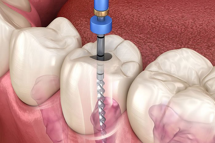 Kanal Tedavileri (Endodonti)