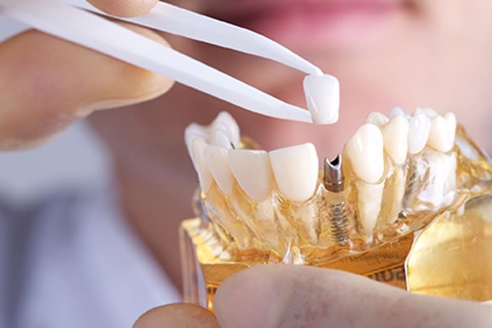 Protetik Diş Tedavisi