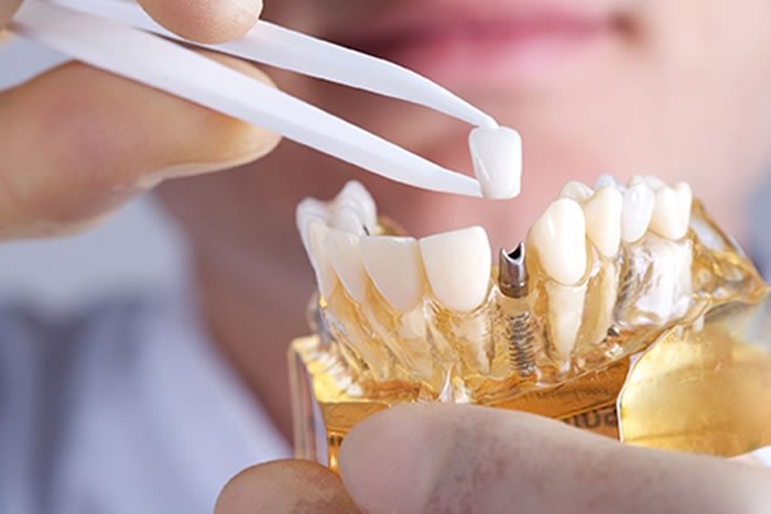 Protez Diş Tedavileri