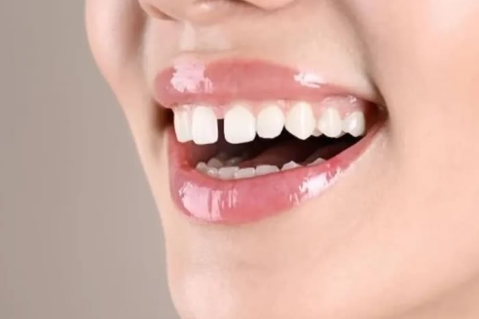 Restoratif Diş Tedavisi