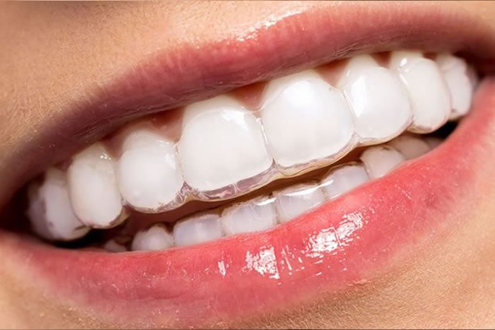 Şeffaf Plak Tedavisi (Invisalign vb.)